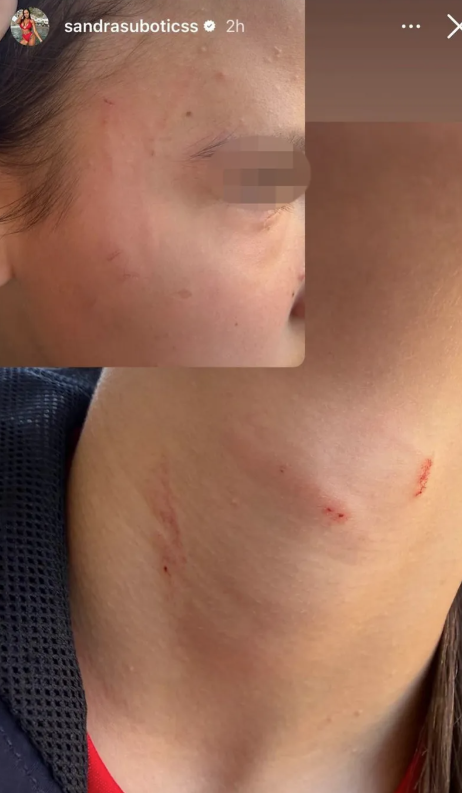 ALEKSANDRA SUBOTIĆ TVRDI DA JOJ JE ĆERKA PRETUČENA! Uznemirujuće fotografije: Ima ogrebotine po licu i vratu