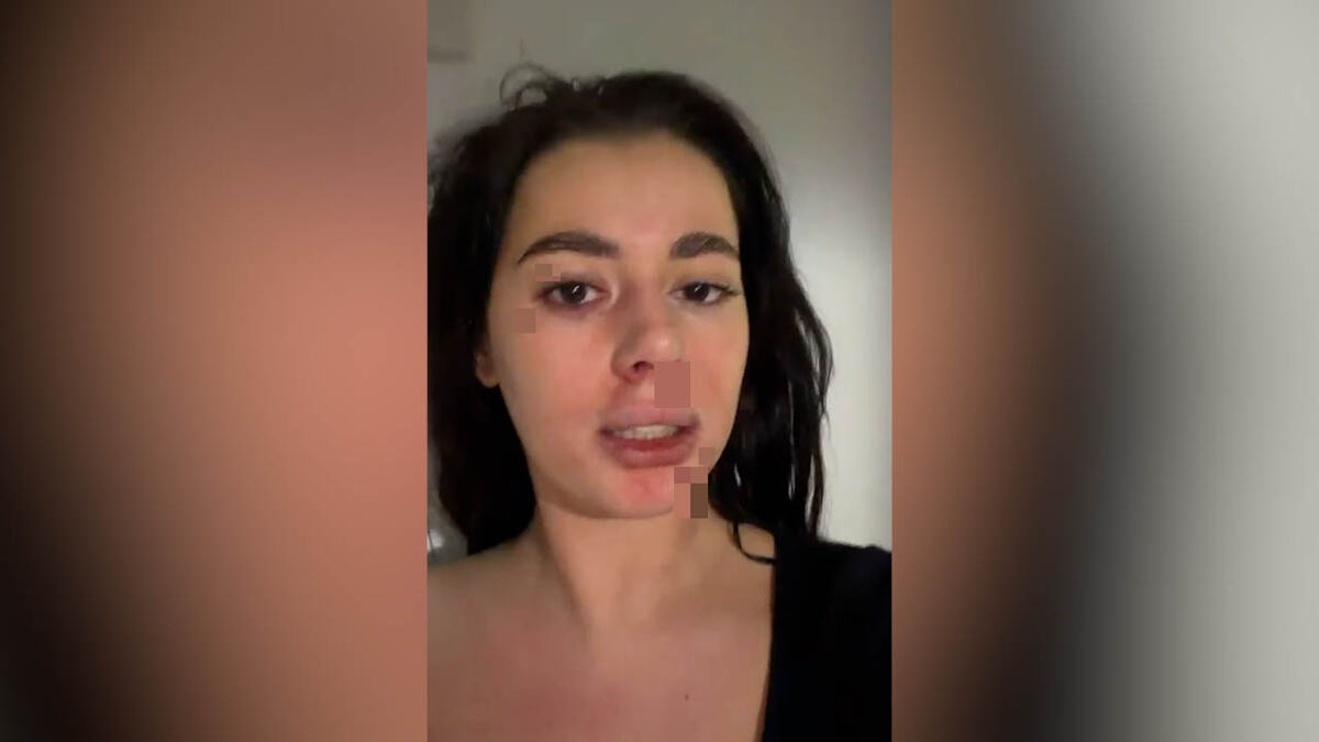 BIVŠA RIJALITI UČESNICA BRUTALNO PRETUČENA! Pronašla poruke u partnerovom telefonu, pa usledio haos: I dalje strahujem za svoju bezbednost... (VIDEO)