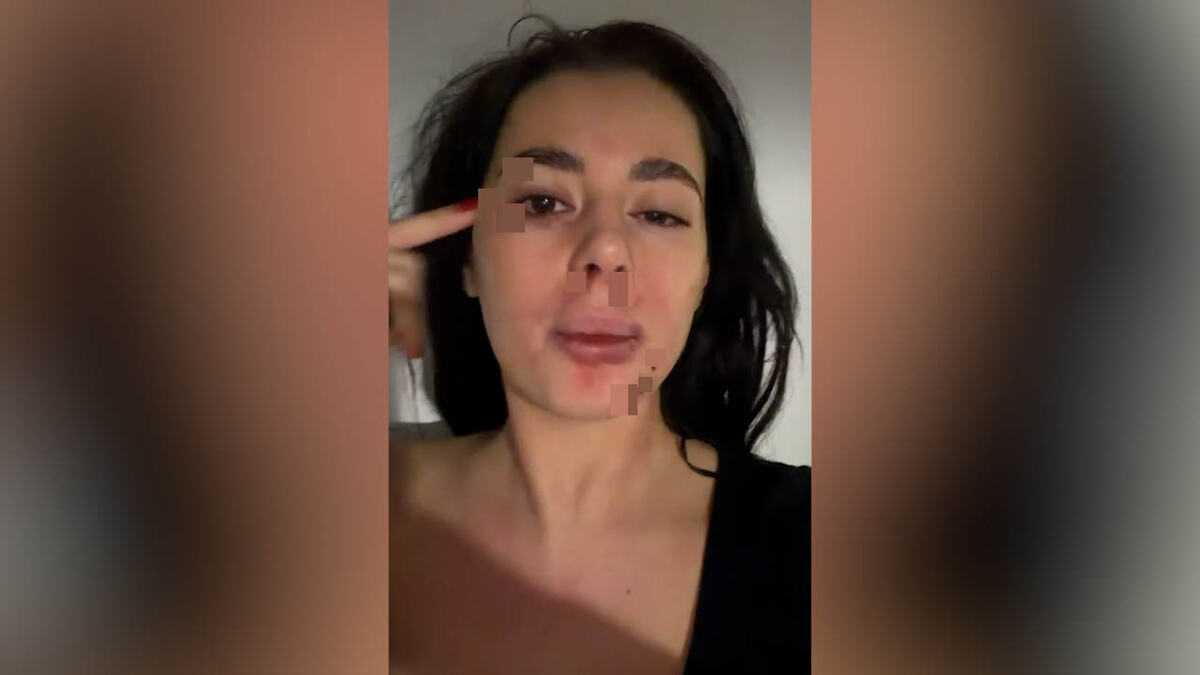 BIVŠA RIJALITI UČESNICA BRUTALNO PRETUČENA! Pronašla poruke u partnerovom telefonu, pa usledio haos: I dalje strahujem za svoju bezbednost... (VIDEO)