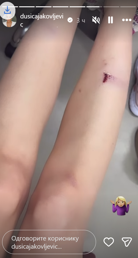 DUŠICA JAKOVLJEVIĆ SE STROPOŠTALA NIZ STEPENICE: Voditeljka u krvi i modricama: Da mi je neko rekao... (FOTO/VIDEO)