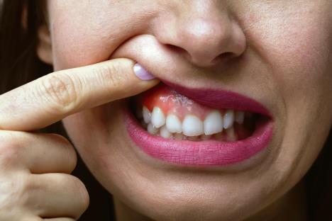 stockphotocloseupofawomansfingershowingswellingofhergum1134004718.jpg