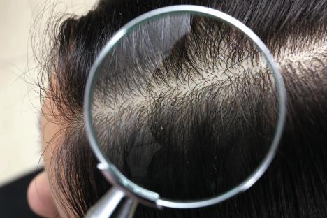 odlicna-preventiva--stockphotocloseupofwomanwithdandruffinherhairviewthroughmagnifyingglass1340080337.jpg