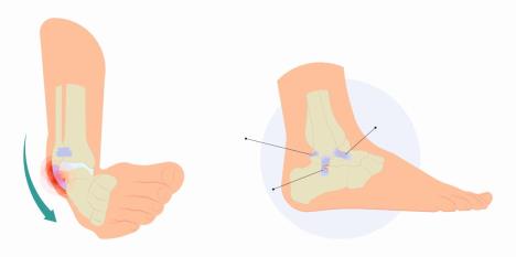 iscasen-zglob-leva-slika--stockvectorinjurytalofibularfoottreathighlowrolltwistteartoughbandsbonejointrangeofmotionpain1909233859-copy.jpg