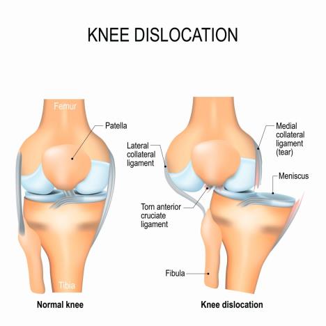 u-cemu-je-razlika-izmeu-ligamenata-i-tetiva--stockphotokneedislocationandnormallateraltraumatothekneetorncollateralligamentscruciate626420591.jpg