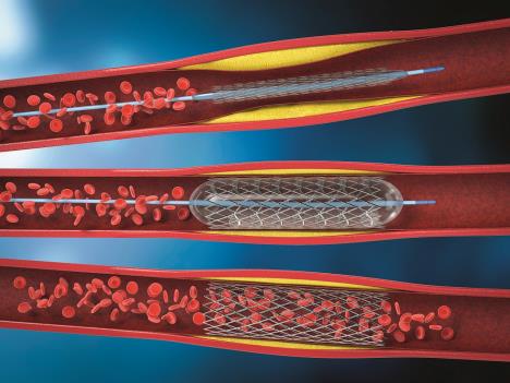 stent-ugradjen-na-vreme-obezbedjuje-dobar-protok-krvi--stockphotodrenderingballoonangioplastyprocedurewithstentinvein1504404380.jpg