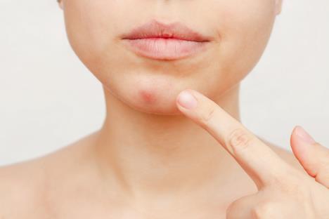 akne-na-bradi-shutterstock-2075109991.jpg