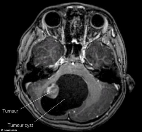 devojcica-pevanje-fals-tumor-cista-mozak.jpg