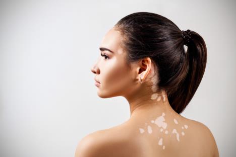 vitiligo-shutterstock-1085070023.jpg