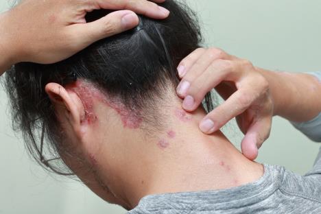 psorijaza-temena-shutterstock-1345272986.jpg