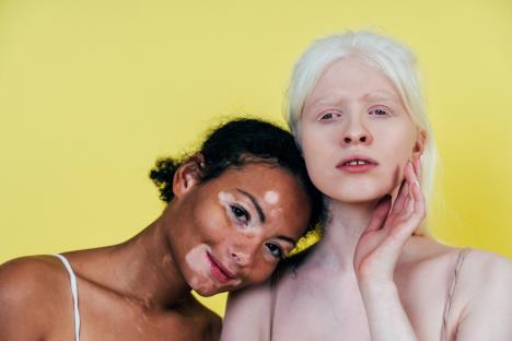 albino-i-virtiligo-shutterstock-1922089568.jpg