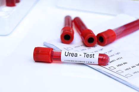 urea-u-krvi-shutterstock-2232678461.jpg