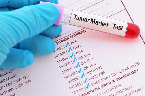 tumor markeri shutterstock_754847362.jpg