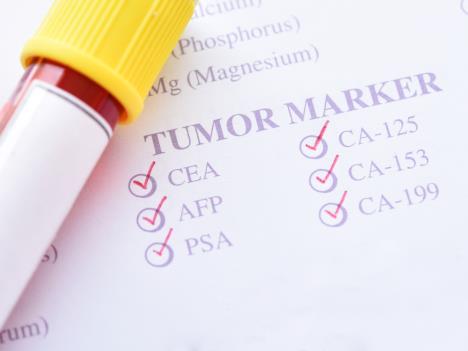 tumor markeri shutterstock_1063446443.jpg