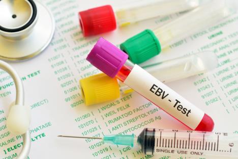 Epstein-Barr virus shutterstock_1054831139.jpg