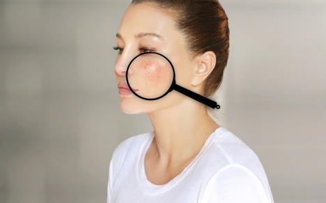 lupus shutterstock_1902489136.jpg