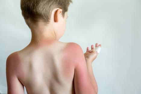 opekotine od sunca shutterstock_1414953179.jpg