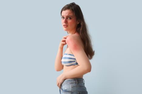 alergija sunce shutterstock_2320676071.jpg