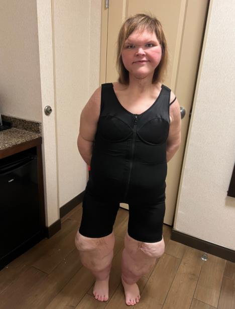 Temi Slejton posle uklanjanja viška kože.jpg