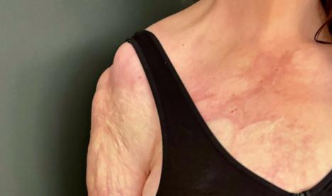 Sari u požaru izgorelo 46% tela