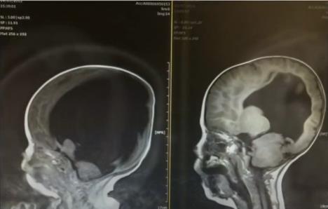 Noa Vol rođen sa 2% mozga
