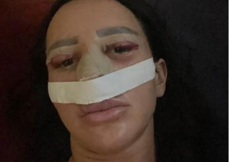 PORŠELINA SVA U ZAVOJIMA, OGLASILA SE IZ BOLNICE! Lice otečeno i u podlivima: Jako se loše osećam, jedva sam se probudila...