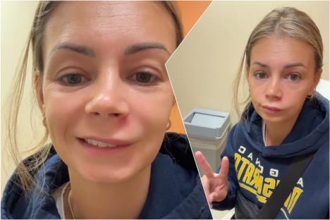 Žena sa upaljenom bubuljicom ispod nosa