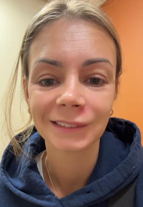 Žena sa upaljenom bubuljicom ispod nosa doživela paralizu lica