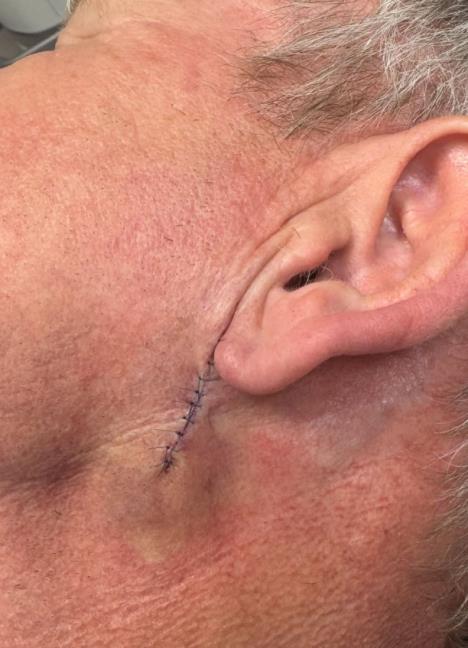 Gordon Remzi operisao rak kože