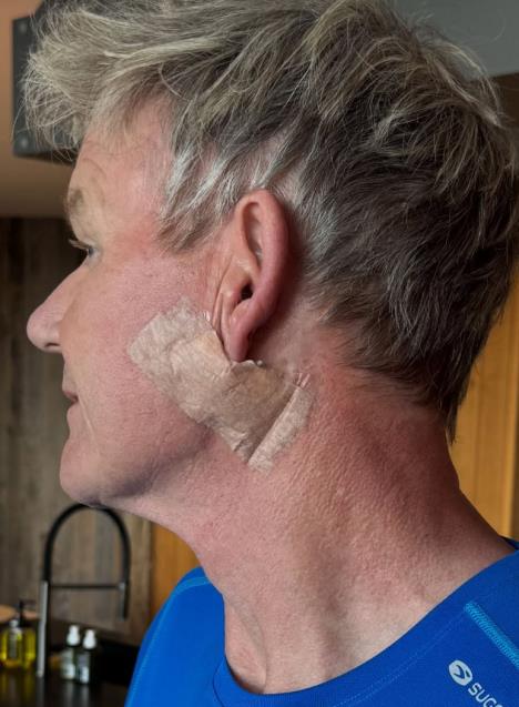 Gordon Remzi operisao rak kože