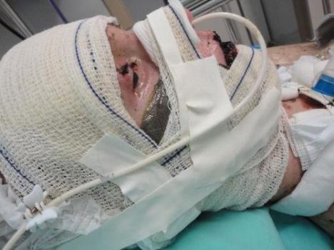 Žaklin Gmak zbog ibuprofena razvila Stivens-Džonsonov sindrom