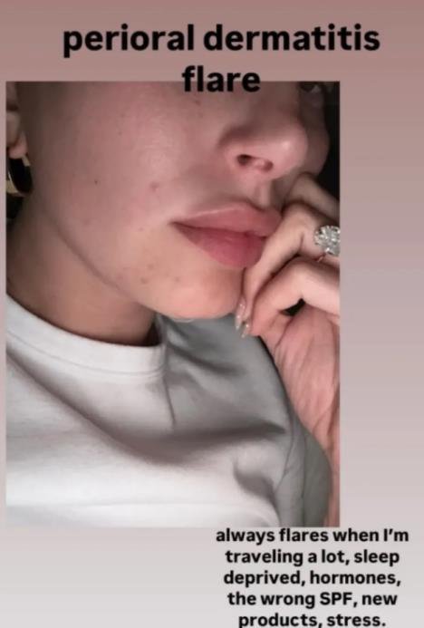 Hejli Biber požalila se na bubuljice koje joj uvek izlaze oko usana