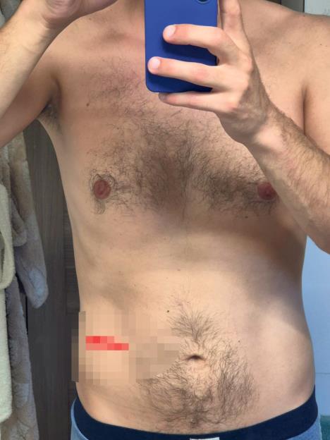 Povreda nožen na stomaku