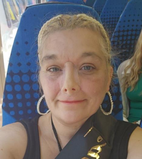 Ellen Louise Mccleary ostala bez nosa