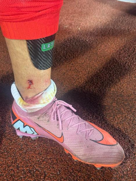 Povreda Rodrigaa na večitom derbiju