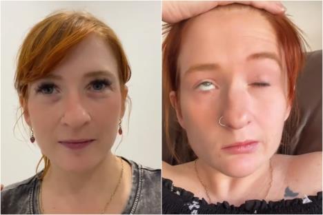 ŽEna sa paralizom lica pre i nakon dijagnoze Belove paralize