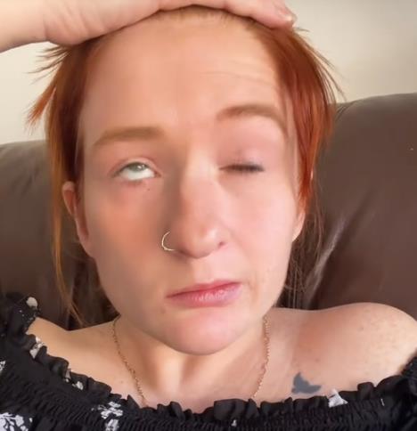 Žena sa paralizom lica nakon dijagnoze Belove paralize