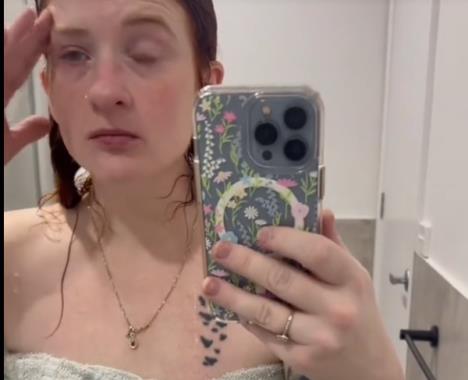 Žena sa paralizom lica nakon dijagnoze Belove paralize