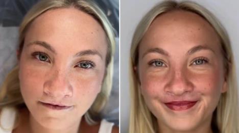 Devojka kozmetičkom tetovažom prekrila zečiju usnu.jpg