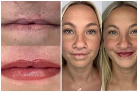 Devojka kozmetičkom tetovažom prekrila zečiju usnu