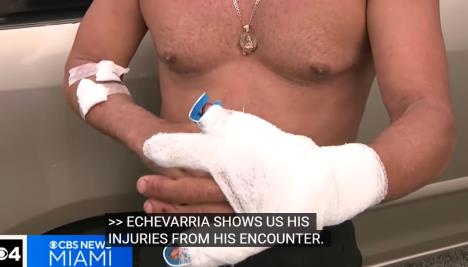 čoveka napala ajkula u majamiju