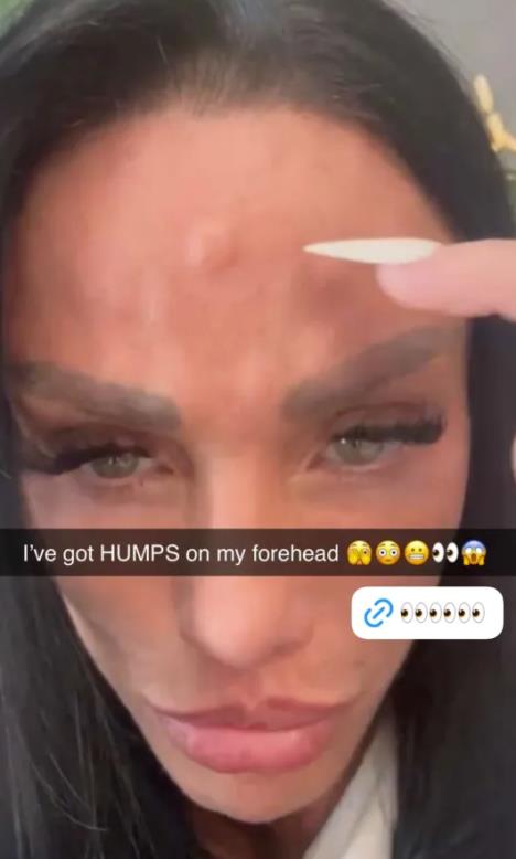 Kejti Prajs botoks izbočine (1).png