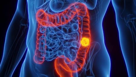 rak debelog creva.jpg