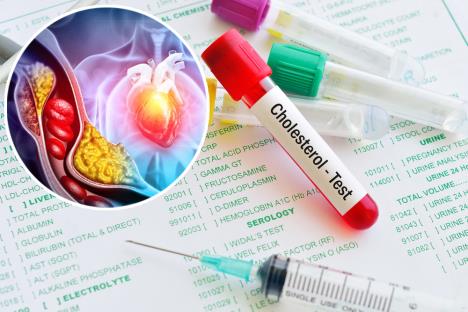 Hologramski prikaz srca i arterije zapušene holesterolom/krvni test holesterol