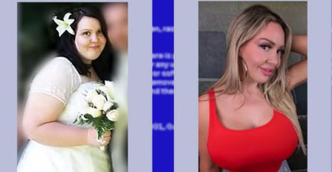 Mendi pre i posle operacije