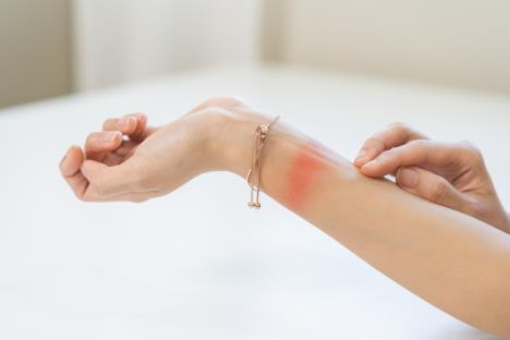 crvenilo na ruci od narukvice