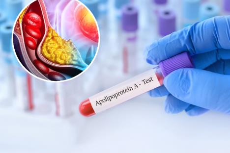 Krvni sud holesterol