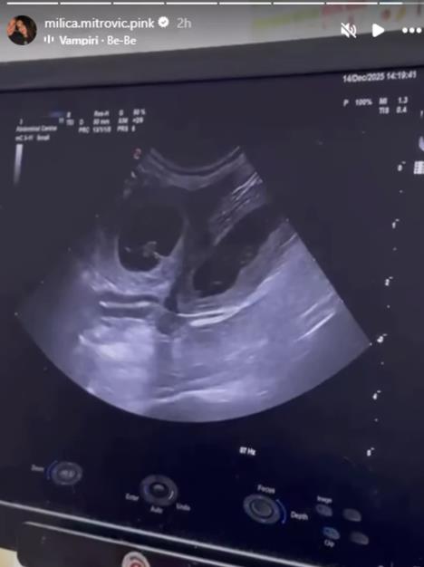 Milica Mitrović podelila snimak ultrazvuka