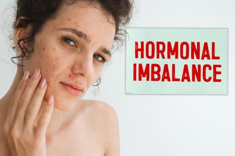 devojka na licu ima akne izazvane hormonskim disbalansom/natpis hormonski disbalans