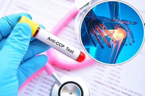 epruveta sa anti CCP testom/bolno koleno, artritis