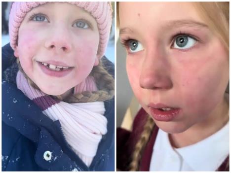 alergija na hladnoću